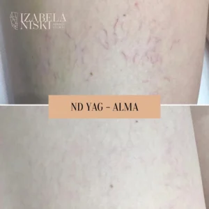 Alma ND YAG ciało