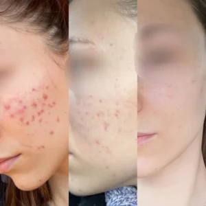 Mezoterapia mikroigłowa