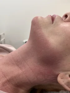 Zabiegi laserowe MULTIFRAX® w Rzeszowie