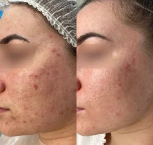 Terapie laczone mezoterapia iglowa kwasy medyczne i divine