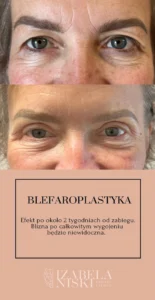 Blefaroplastyka