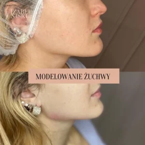 Modelowanie żuchwy