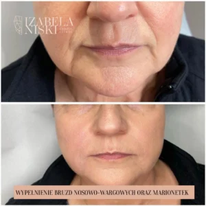 Wypełnienie bruzd wargowo nosowych