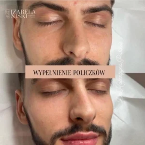 Wypełnienie policzków